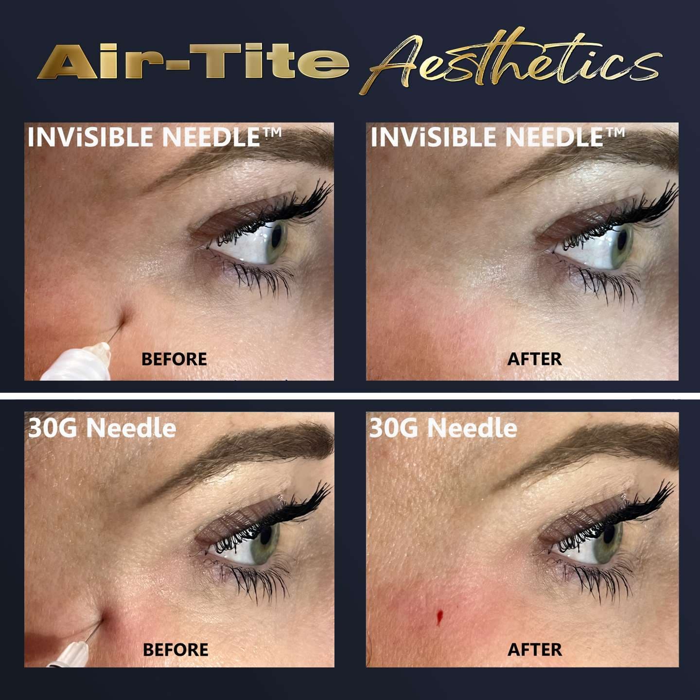 TSK The Premium Invisible Hypodermic Needle - Image 2