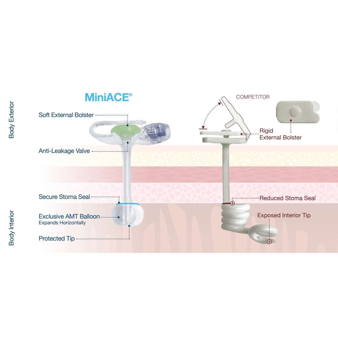 MiniACE Enema Button Device - Image 2