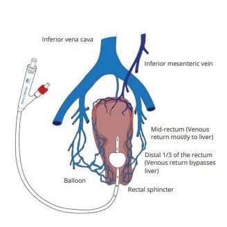 The Macy Catheter Rectal Medication Administration System, Bedside Care Kit - Image 3