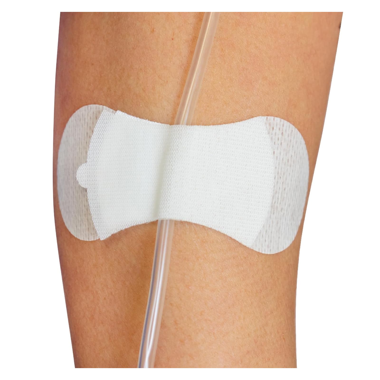 Grip-Lok General Securement Device for Universal Catheter